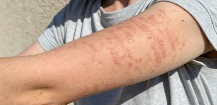 Top 5 : Erreurs fréquentes à éviter quand on a de l’urticaire